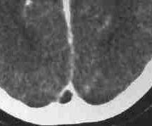 Mri Library Sinusvenenthrombose