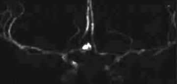 Aneurysma des Ramus communicans anterior MR-Angiographie