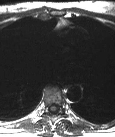 Mammaria int. Lymphknoten, T1 axial