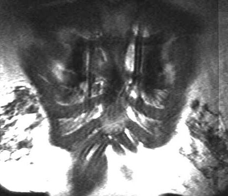 Mammaria int. Lymphknoten, T1 frontal entlang des Brustbeines