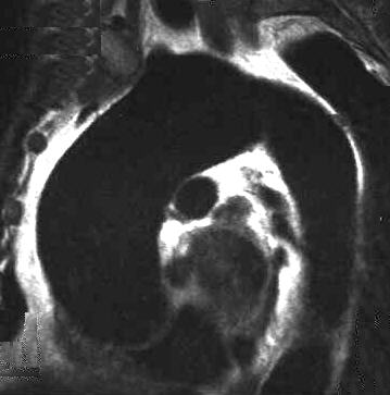Aortenaneurysma, T1 gewinkelt sagittal