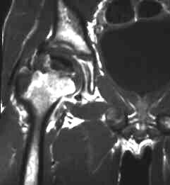 M. Perthes, frontal T1