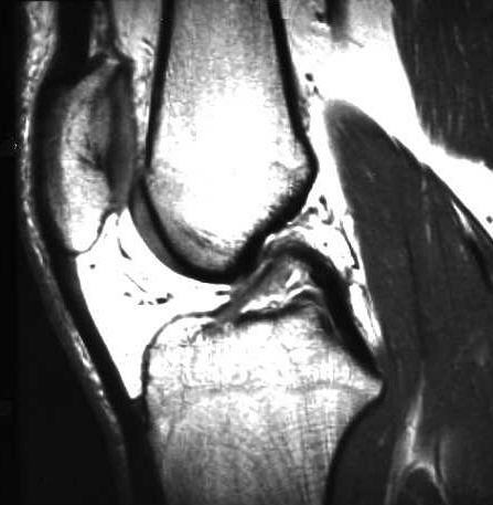 normale Kreuzbnder, T1 sagittal