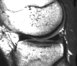 normaler Auenmeniskus, T1 sagittal