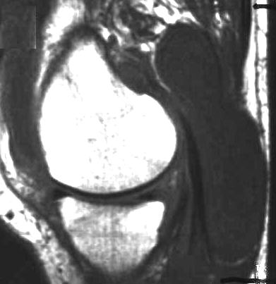 Bakerzyste, T1 sagittal