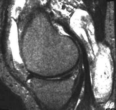 Bakerzyste, T2 sagittal