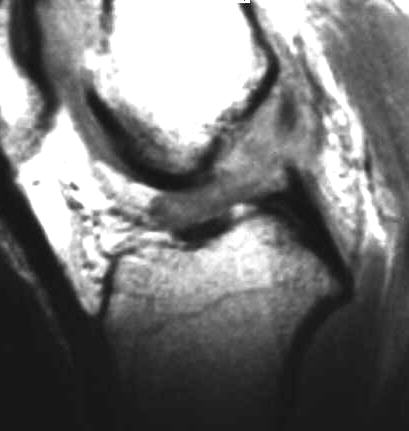 vordere Kreuzbandruptur, T1 sagittal