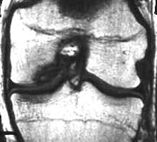 Osteochondrose, T1 i.v. KM, coronal