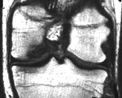 Osteochondrose, T1, coronal