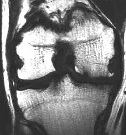 Arthrose, T1 coronal