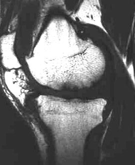 Arthrose, T1 sagittal