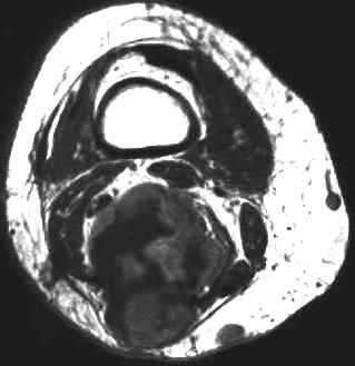 Leiomyosarkom, T1 i.v. KM axial