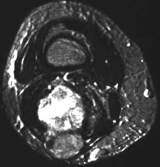 Leiomyosarkom, T2 i.v. KM axial