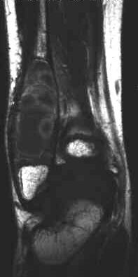 Enchondrom, T1 i.v.KM cornal