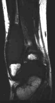 Enchondrom, T1 cornal