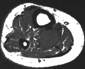 Neurinom des N. tibialis, T1 axial