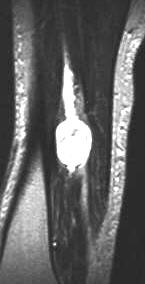 Neurinom des N. tibialis, T2 sagittal