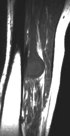 Neurinom des N. tibialis, T1 sagittal