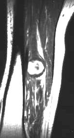 Neurinom des N. tibialis, T1 i.v. KM sagittal