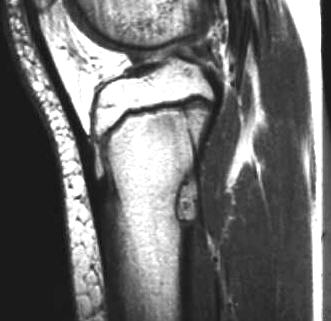 fibrser Corticalisdefekt, T1 i.v. KM sagittal