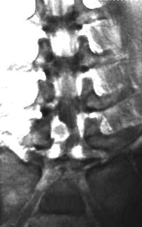 Bandscheibenprolaps LWK 4/5, T1 coronal