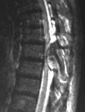 Metastase, T2 sagittal