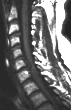 HWS Bandscheibenprolaps, T1 sagittal