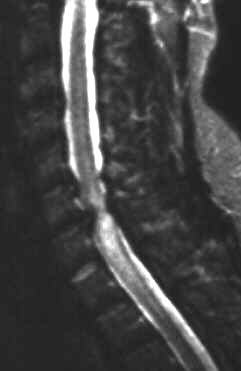 HWS Bandscheibenprolaps, Myelopathie, T2 sagittal