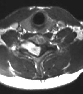 spinales Haemangiom, T1 axial