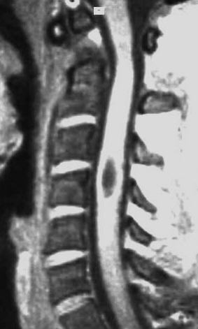 HWS Syringomyelie, T1 sagittal