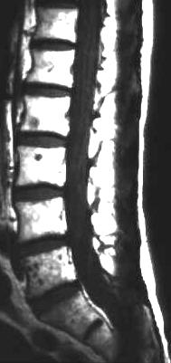 Meningiosis carcinomatosa, T1 sagittal